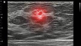 Ulstrasound of breast tumor, I am going to need more chemo treatment.